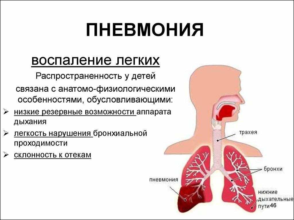 Признаки пневмонии у ребёнка: как распознать воспаление лёгких, симптомы, лечение в стационаре и в домашних условиях
