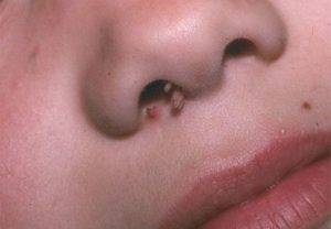 Причины и лечение корок в носу