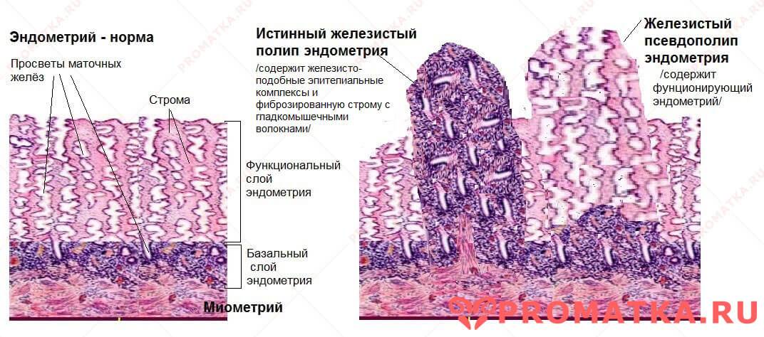 Фиброзный полип цервикального канала фото