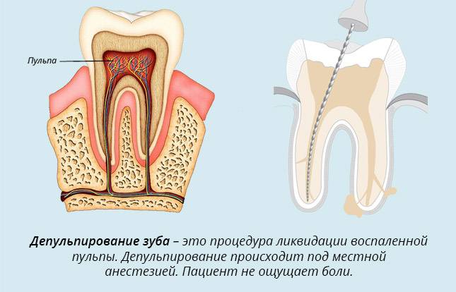 Депульпирование зуба перед протезированием: зачем и когда проводят?