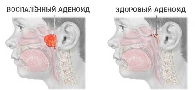 Постоянный насморк и заложенность носа — причины, что делать?