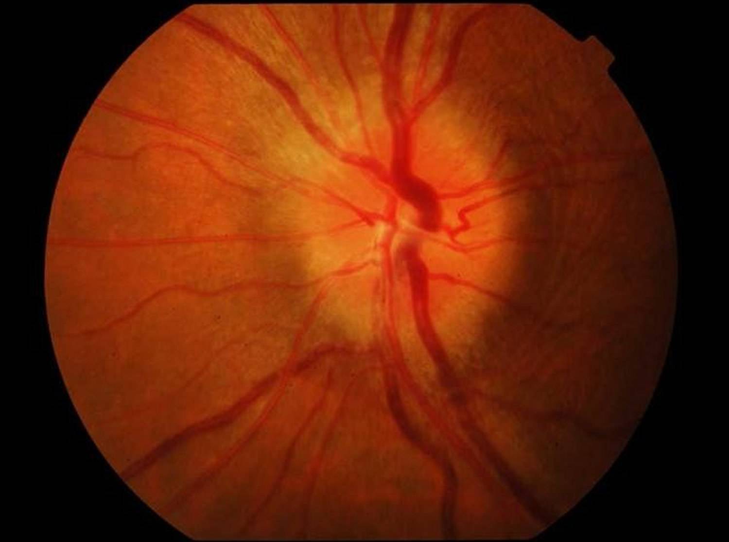 Атрофия зрительного нерва - причины, симптомы, диагностика и лечение