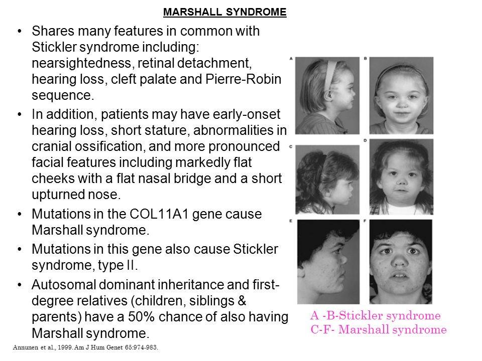 Синдром маршалла - причины, симптомы и возможные осложнения