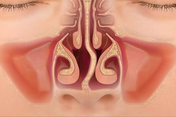 Другие болезни носа и носовых синусов. код по мкб-10 j34
