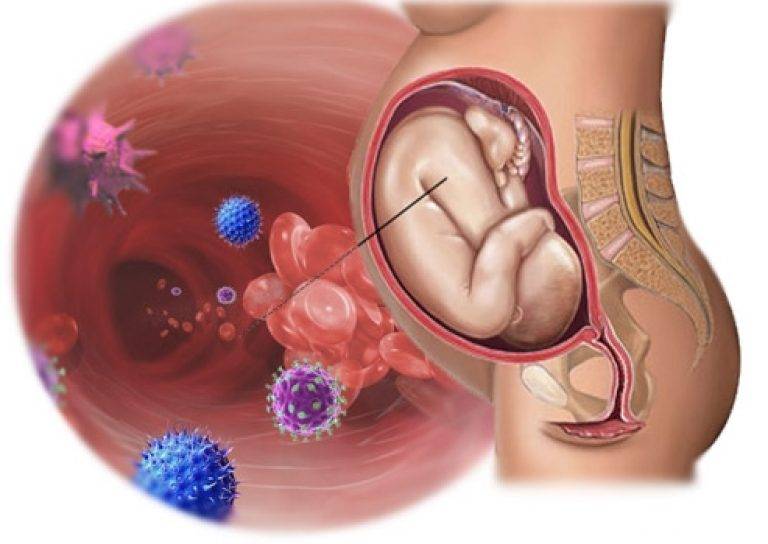 Тонзиллит при беременности: симптомы, лечение, последствия