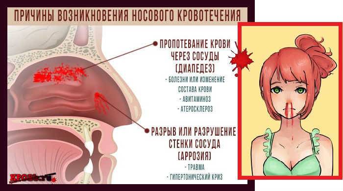 При сморкании кровь из носа при беременности; причины