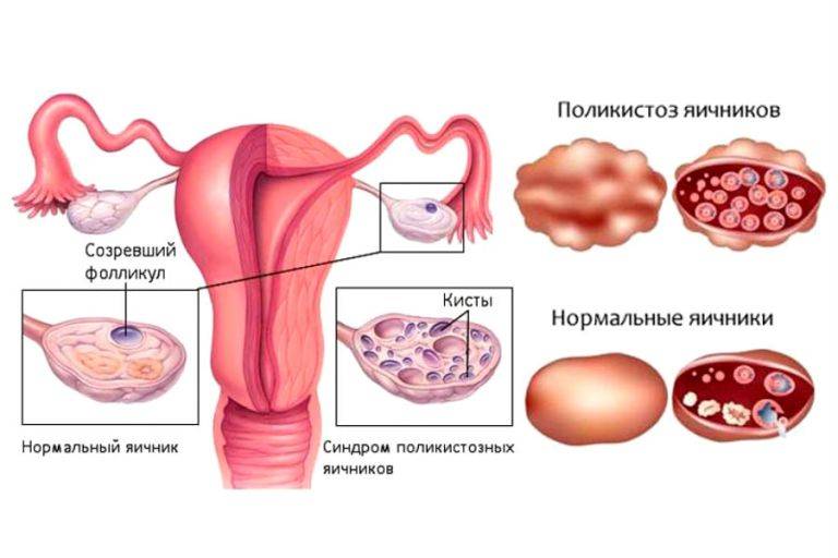 Дисфункция яичников | симптомы | диагностика | лечение - docdoc.ru