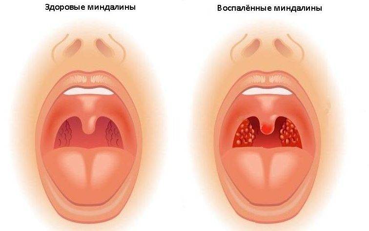 Отличие острого тонзиллита от ангины. чем отличается тонзиллит от ангины: какая разница между ними? как проходит лечение ангины - заболевания