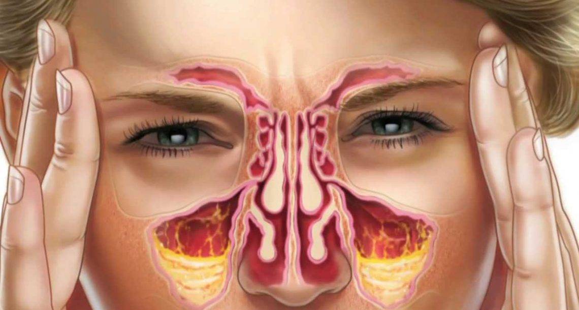Заложенность носа без насморка: причины и лечение народными средствами