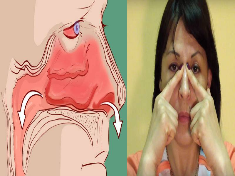 Сильный насморк и заложенность носа чем лечить народные средства