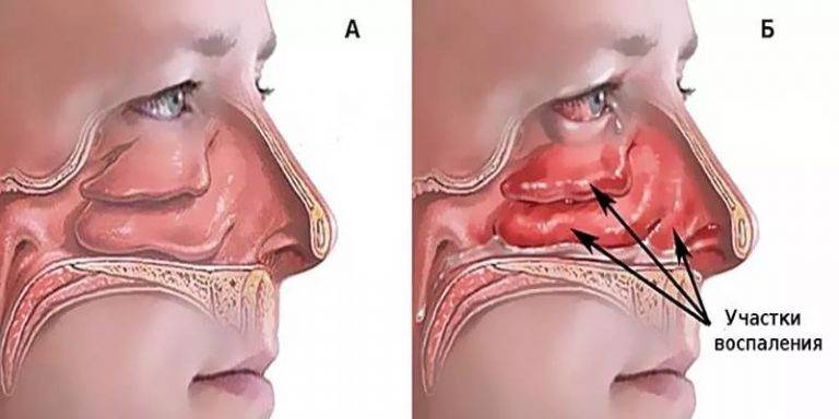 Полипы в носу у ребенка: фото, симптомы и чем лечить?