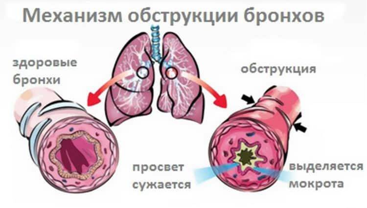 Признаки бронхита у детей без температуры pulmono.ru
признаки бронхита у детей без температуры
