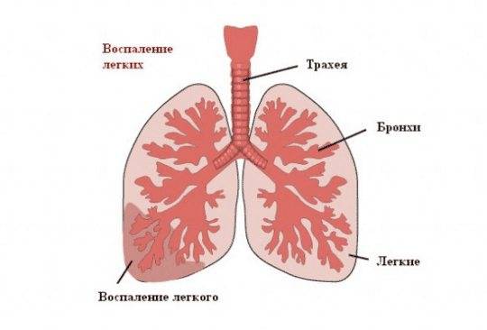 Инфекционная пневмония: симптомы, лечение и причины