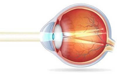 Операция при астигматизме на глаза: виды, стоимость