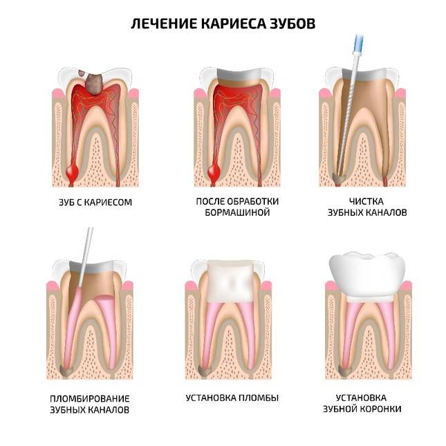 Как лечить кариес зубов: современные методы, этапы, куда обратиться