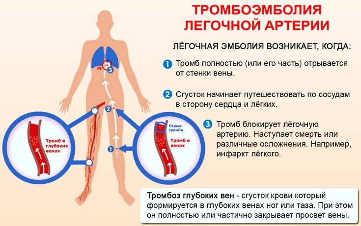 Тромбоэмболия легочной артерии. симптомы, признаки, диагностика, лечение