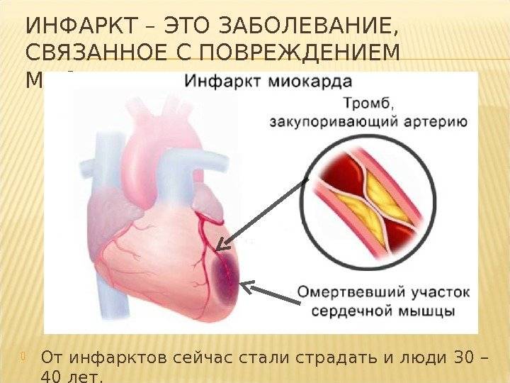 “стенокардия — риск инфаркта: что делать во время приступа?”