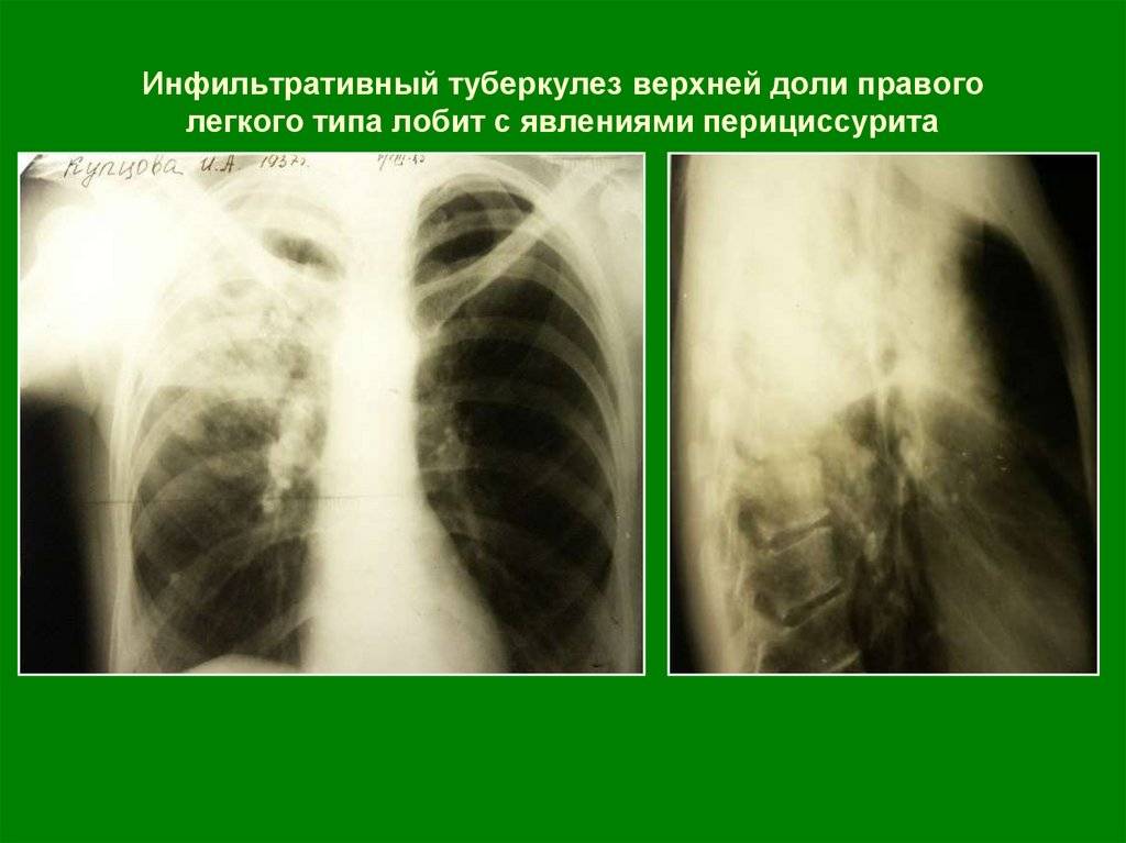 Выявление инфильтративного туберкулеза верхней доли правого легкого: симптомы, лечение, прогноз — стоптубик