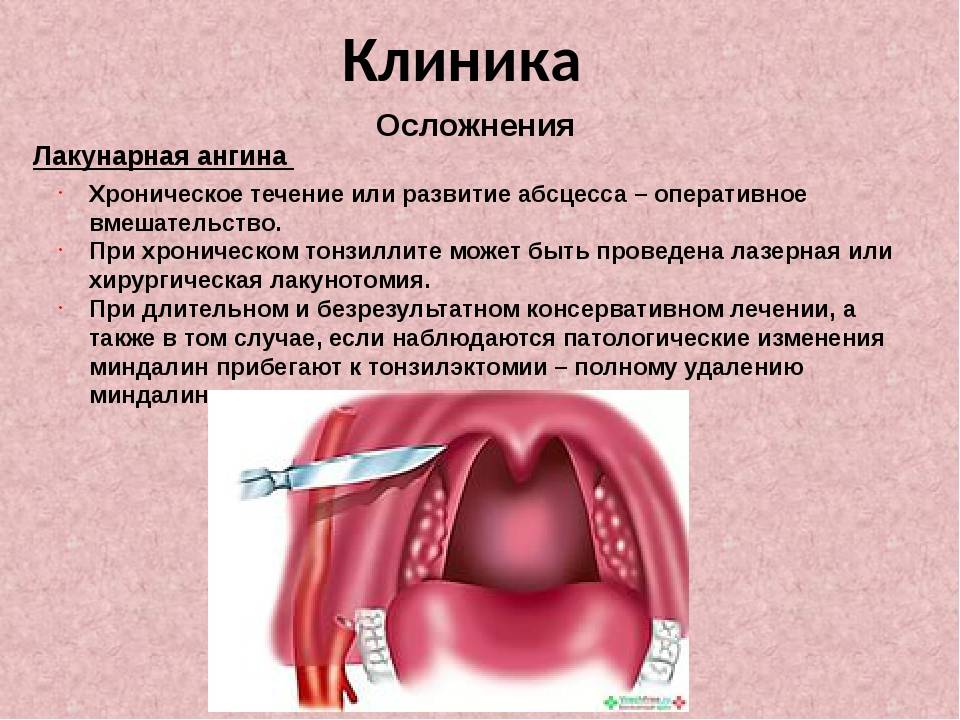 Катаральная ангина: фото миндалин, симптомы и лечение — чтобы горло не болело