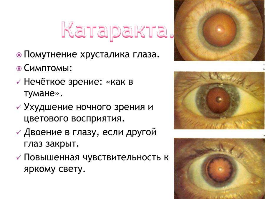 Как вылечить катаракту народными средствами: советы, рецепты - "здоровое око"