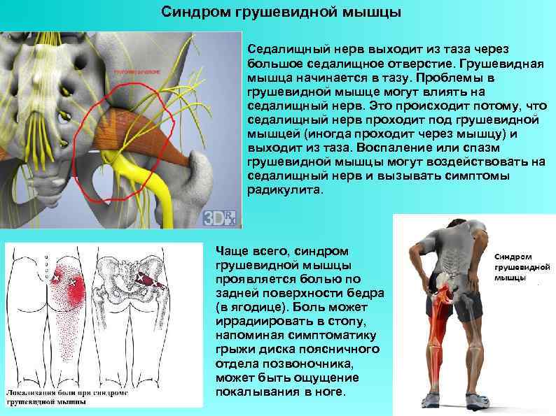 Синдром грушевидной мышцы - симптомы и лечебная гимнастика