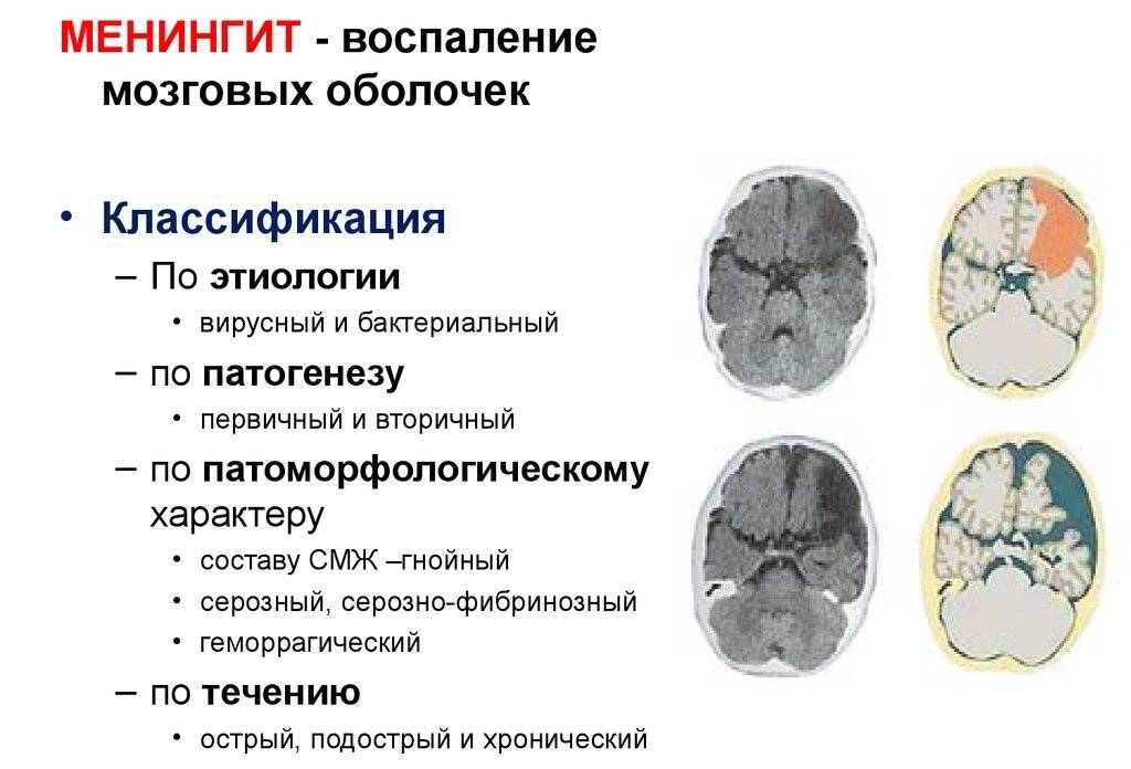 Мастоидит уха: что это такое, характеристика, симптомы и лечение у взрослого, прогноз при правостороннем и левостороннем головного мозга