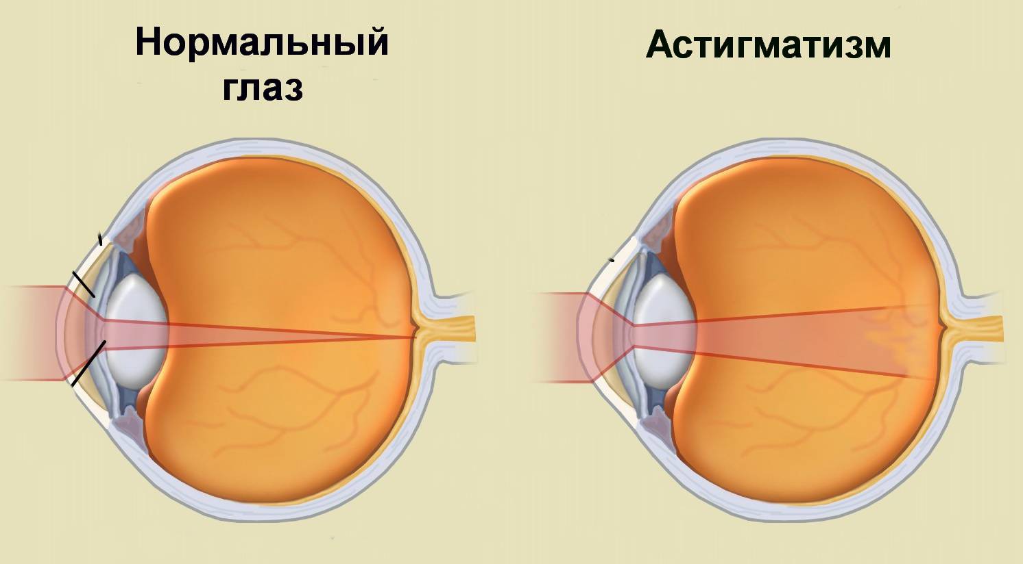 Сложный астигматизм обоих глаз: что это такое,симптомы и лечение