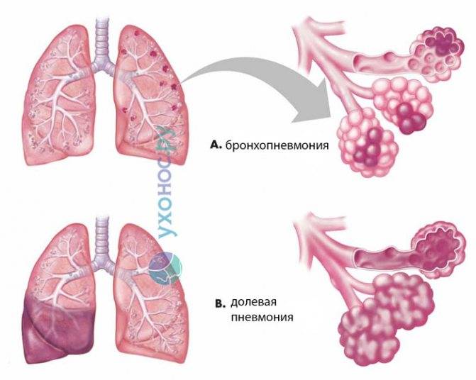 Особенности и течение заболевания очаговой пневмонии