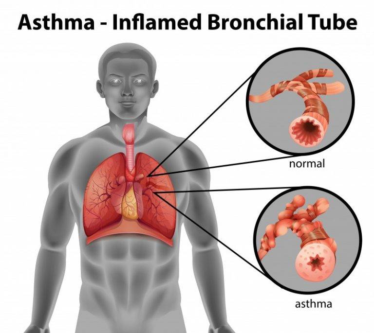Бронхиальная астма: классификация, виды, степени тяжести