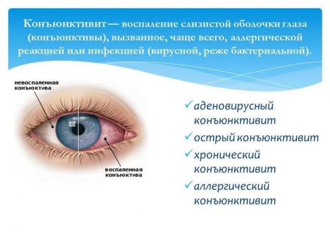 Бактериальный конъюнктивит глаз: лечение у детей