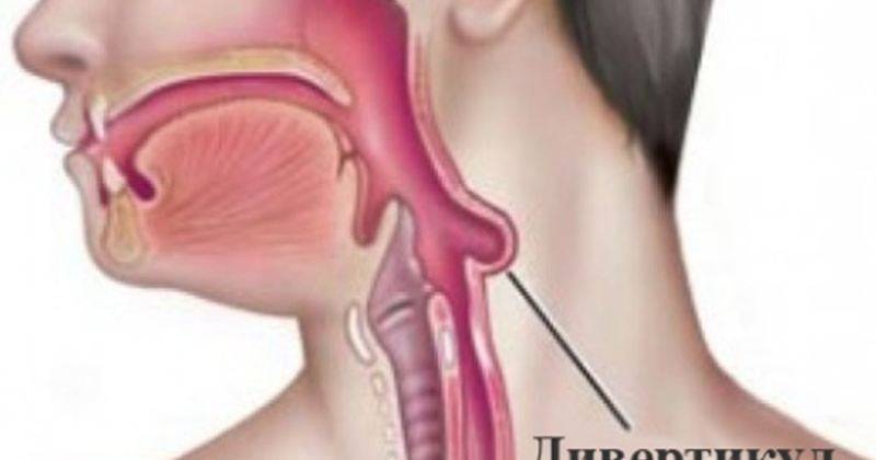 Комок в горле: причины и лечение ощущения инородного тела, как будто что-то мешает