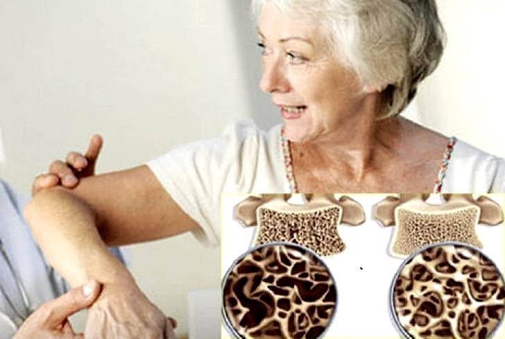 Как лечить остеопороз у женщин, а не его симптомы