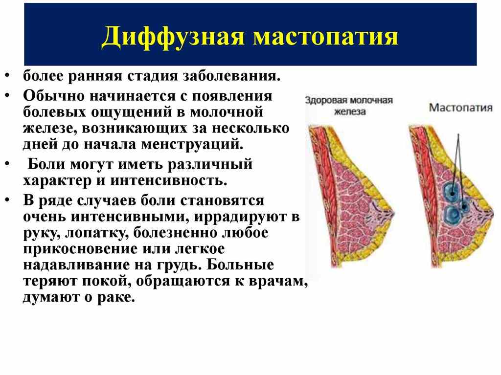 ᐉ климакс и мастопатия лечение народными средствами - sp-medic.ru