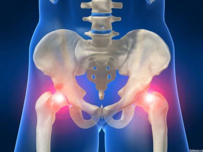 Лечение артрита тазобедренного сустава: препараты и способы