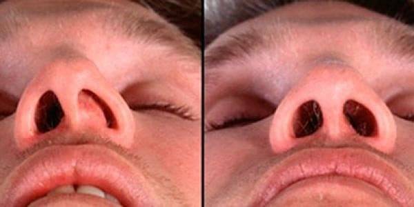 Искривление перегородки носа: симптомы и виды патологии, диагностика и лечение