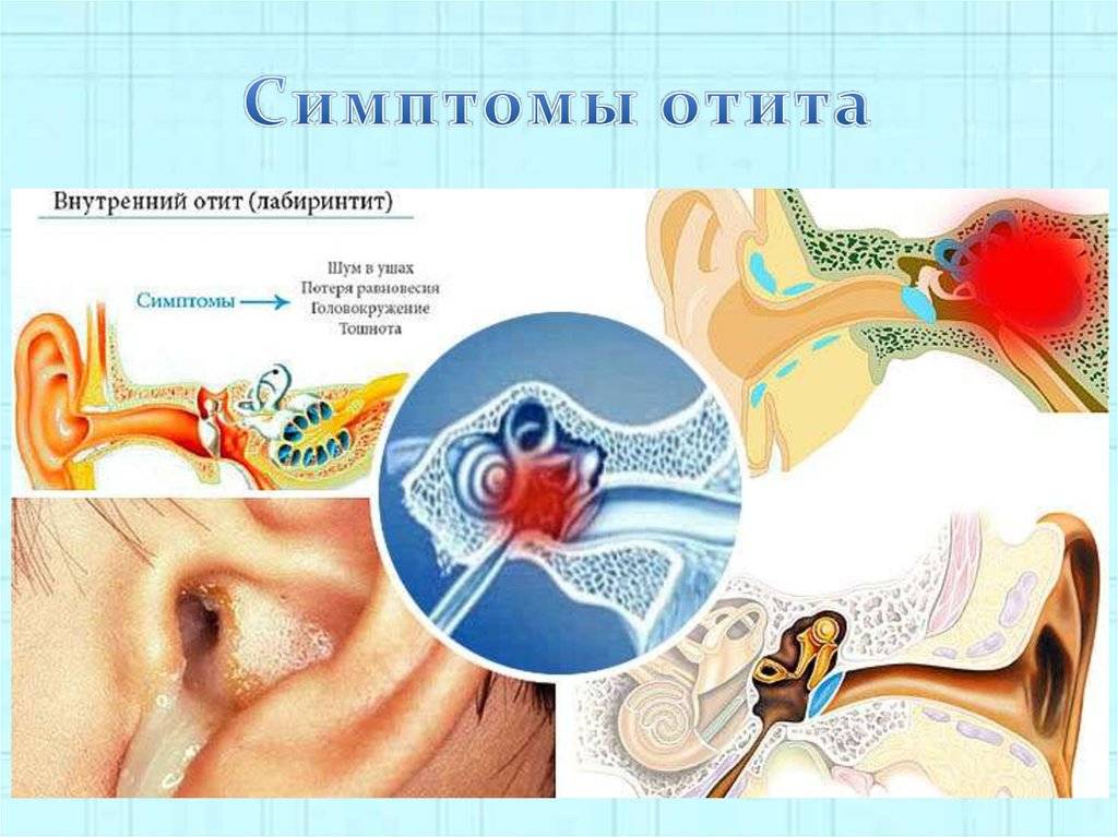 Отит наружного уха — симптомы и лечение воспаления