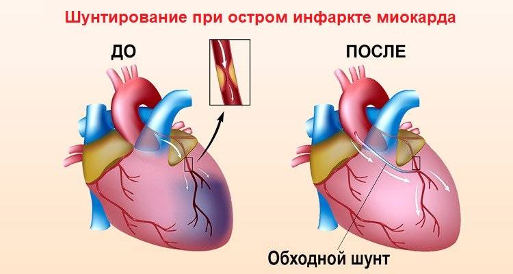 Осложнения инфаркта миокарда: последствия и осложнения