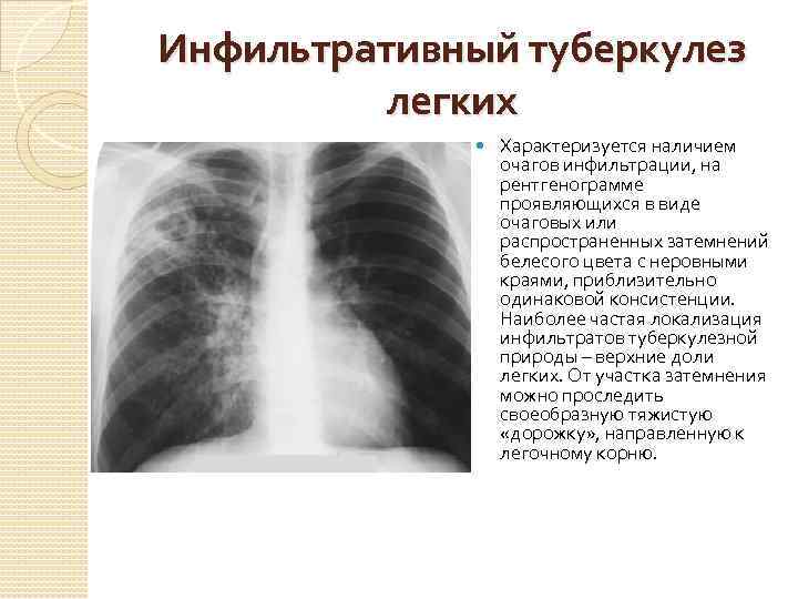 Инфильтративный туберкулез заразен или нет - медицинская помощь