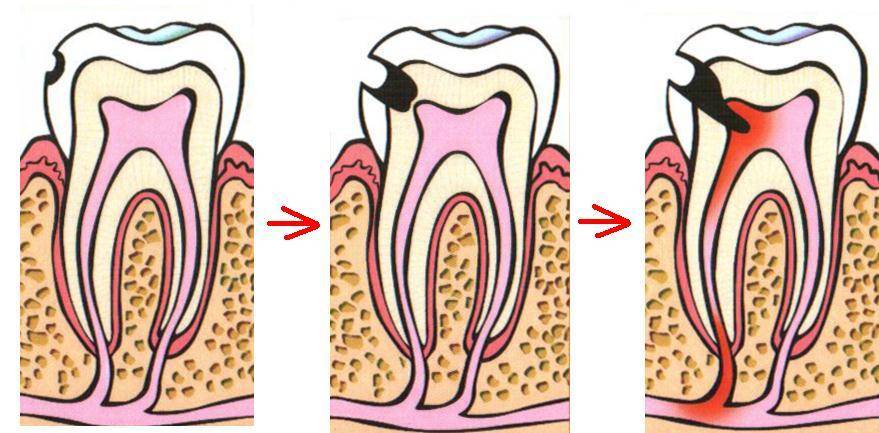 Депульпирование зуба перед протезированием – зачем и как проводится процедура