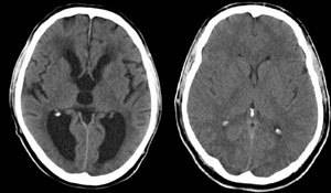 Наружная гидроцефалия головного мозга: что это такое, признаки и лечение