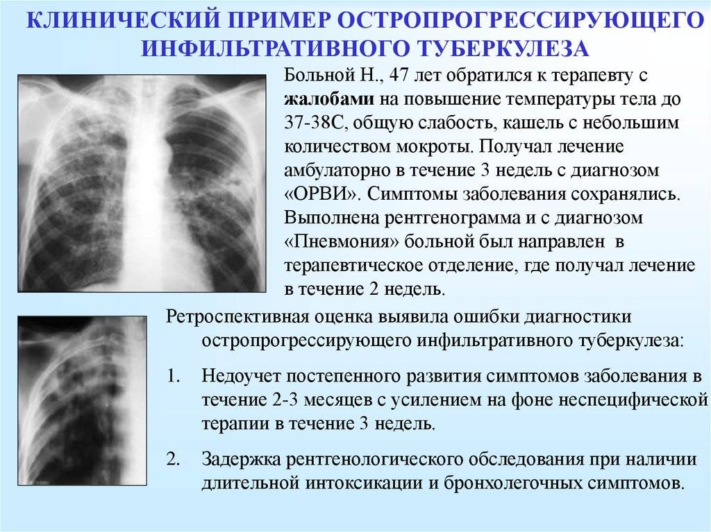 Первые признаки, диагностика, лечение и профилактика туберкулеза легких у детей