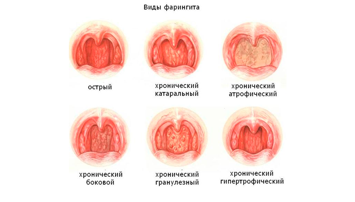 Фарингит, ларингит и трахеит: симтомы, лечение, различия pulmono.ru
фарингит, ларингит и трахеит: симтомы, лечение, различия