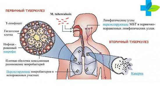 Как передается туберкулез легких - каким путем от человека, как можно заразиться чахоткой с мокротой, воздушно-капельным