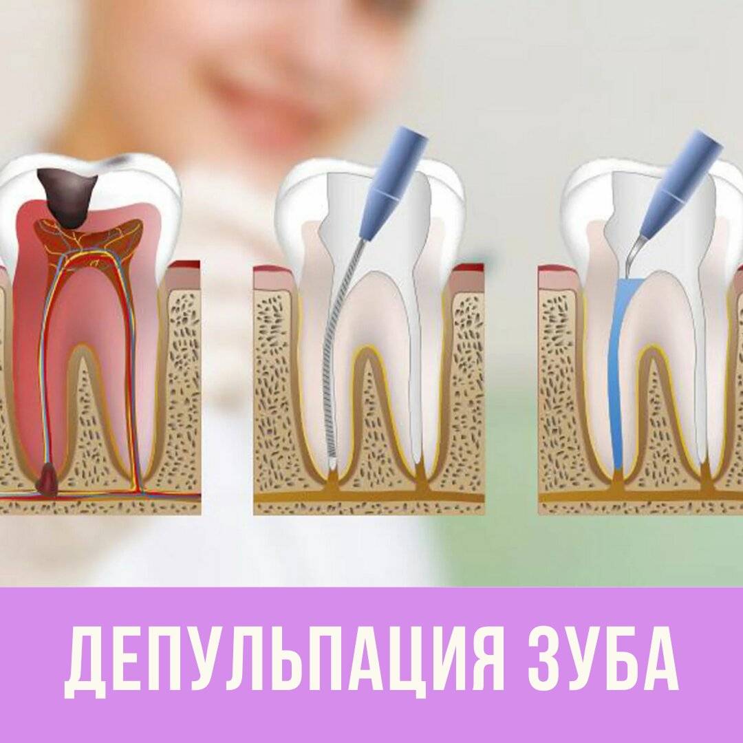 Депульпирование зуба перед протезированием: что такое, как проводится после удаления, нужно ли делать под металлокерамику