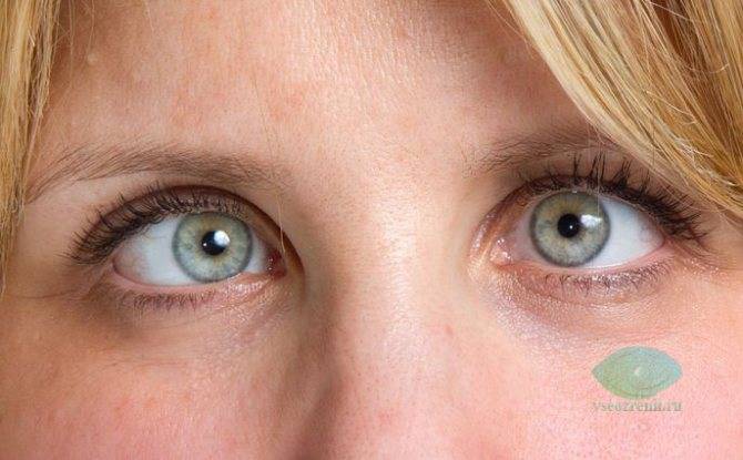 Диплопия: причины развития, симптомы и возможность лечения двоения в глазах