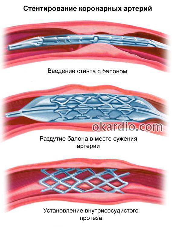 Стентирование коронарных артерий (сосудов сердца): кому показана, как проводят, результат и реабилитация
