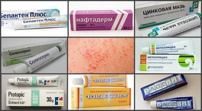 Эффективные средства от дерматита: таблетки, уколы, препараты для местного применения
