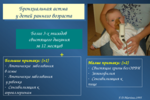 Бронхиальная астма у детей: симптомы, лечение и профилактика