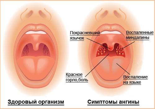 Герпетическая ангина у детей: симптомы и особенности лечения