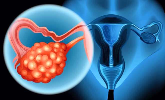 Как проявляется дисфункция яичников репродуктивного периода